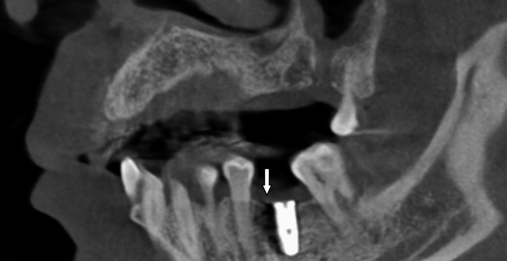 Coupe CBCT sagittale montrant un implant dentaire positionné en secteur antérieur avec visualisation de la profondeur d'insertion sous la gencive et des structures osseuses adjacentes