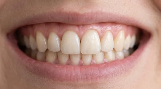 Gros plan d'un sourire adulte montrant des incisives et canines avec une restauration implantaire parfaitement intégrée à la dentition naturelle, dans une lumière douce sur fond neutre